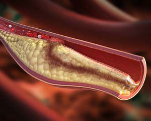 Alirocumab skutecznie obniża cholesterol LDL u diabetyków