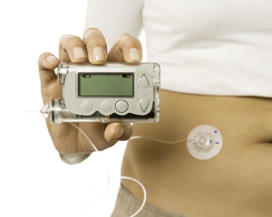 Osobista pompa insulinowa pomaga wyrównać glikemię w cukrzycy typu 1